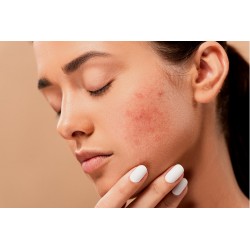 Visage de femme avec acné